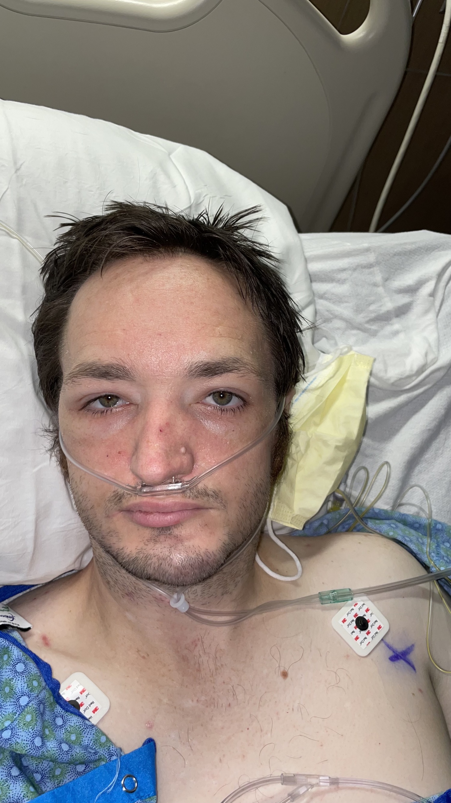 A Mini-Post Update (a residual complication; second surgery)